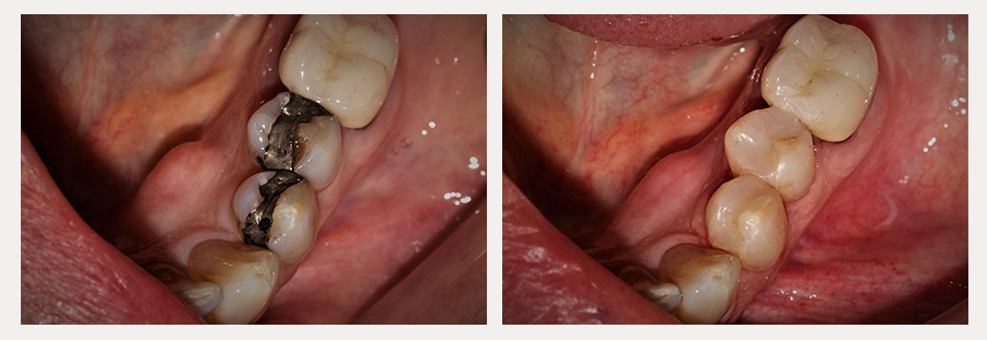 before and after of a dental patient with esthetic composite dental fillings