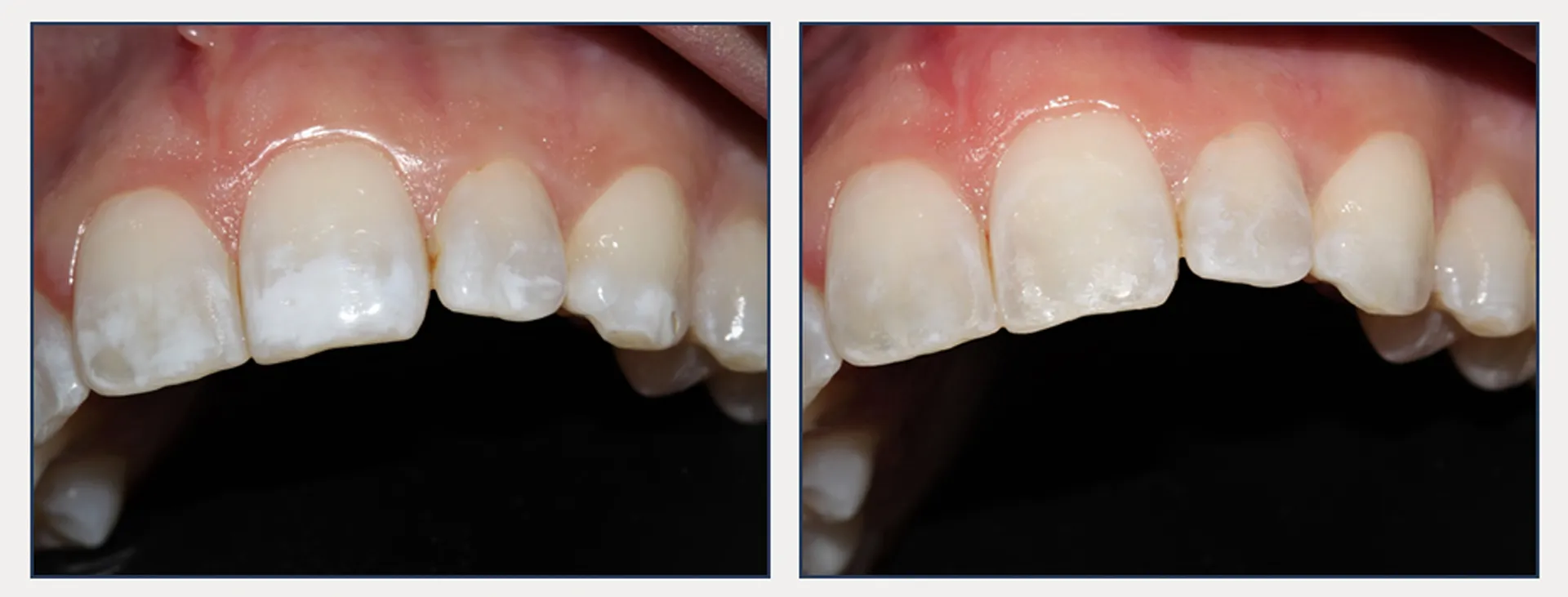 Microabrasion to Remove White Spot Lesions