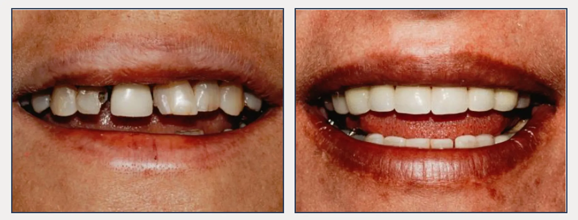 Cosmetic Smile Makeover