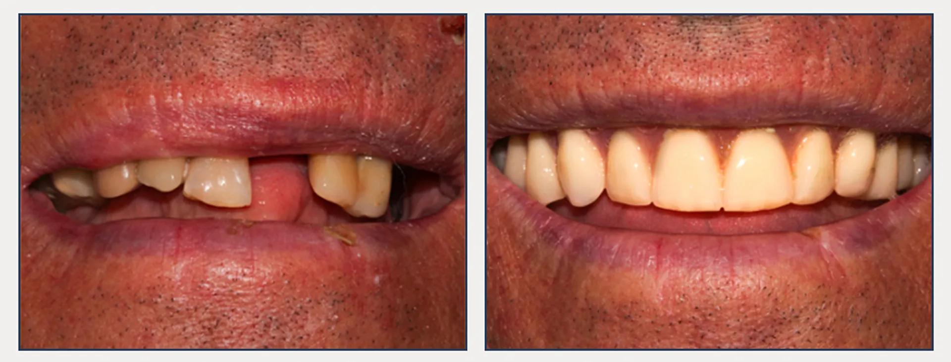 Immediate Complete Dentures