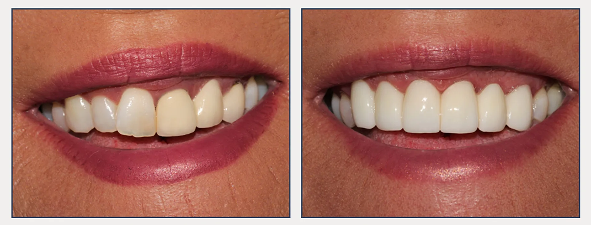 Cosmetic Crowns and Bridges