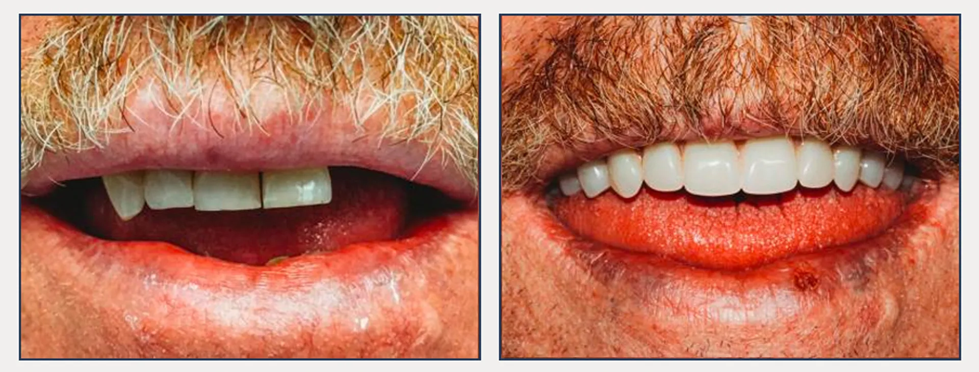 Palate Free Mini Implant Supported Overdentures