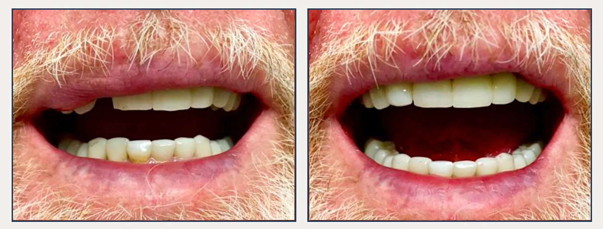 Single Tooth Implant And Crown