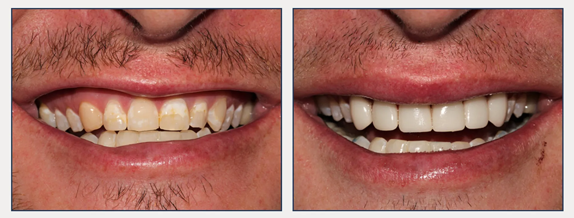 Veneers