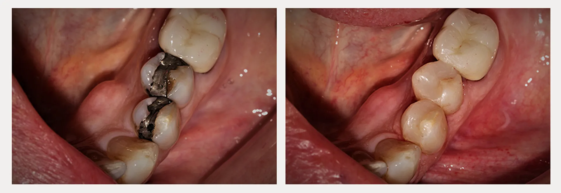 Esthetic Composite Dental Fillings