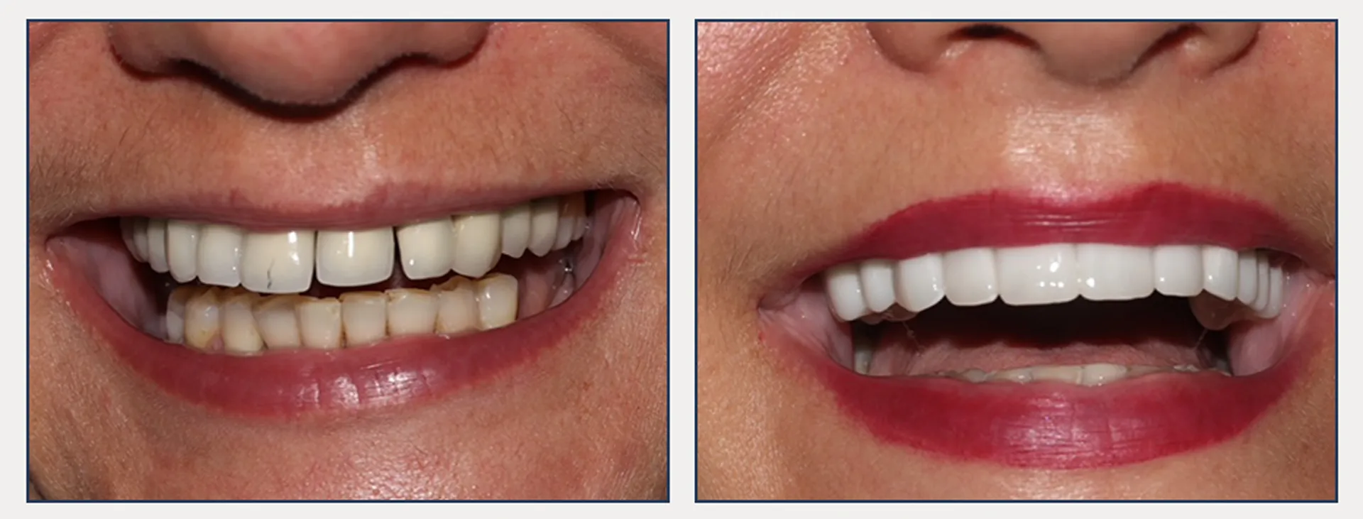 Digital Cosmetic Smile Makeover