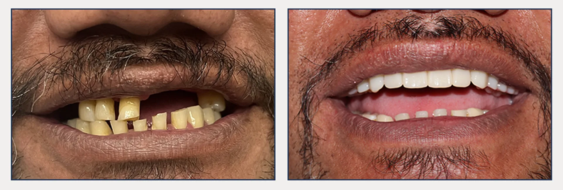 Full Mouth Rehabilitation