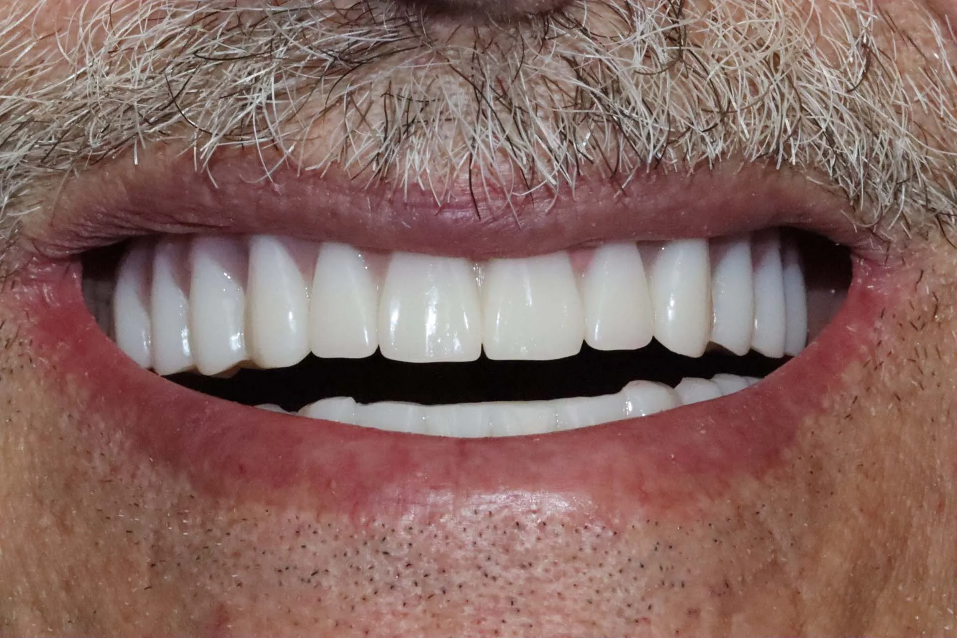 Digital Cosmetic Smile Makeover