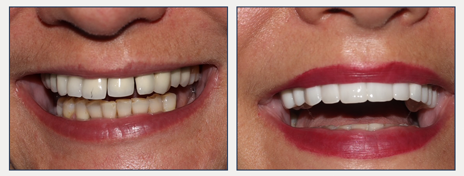 before and after Digital Cosmetic Smile Makeover