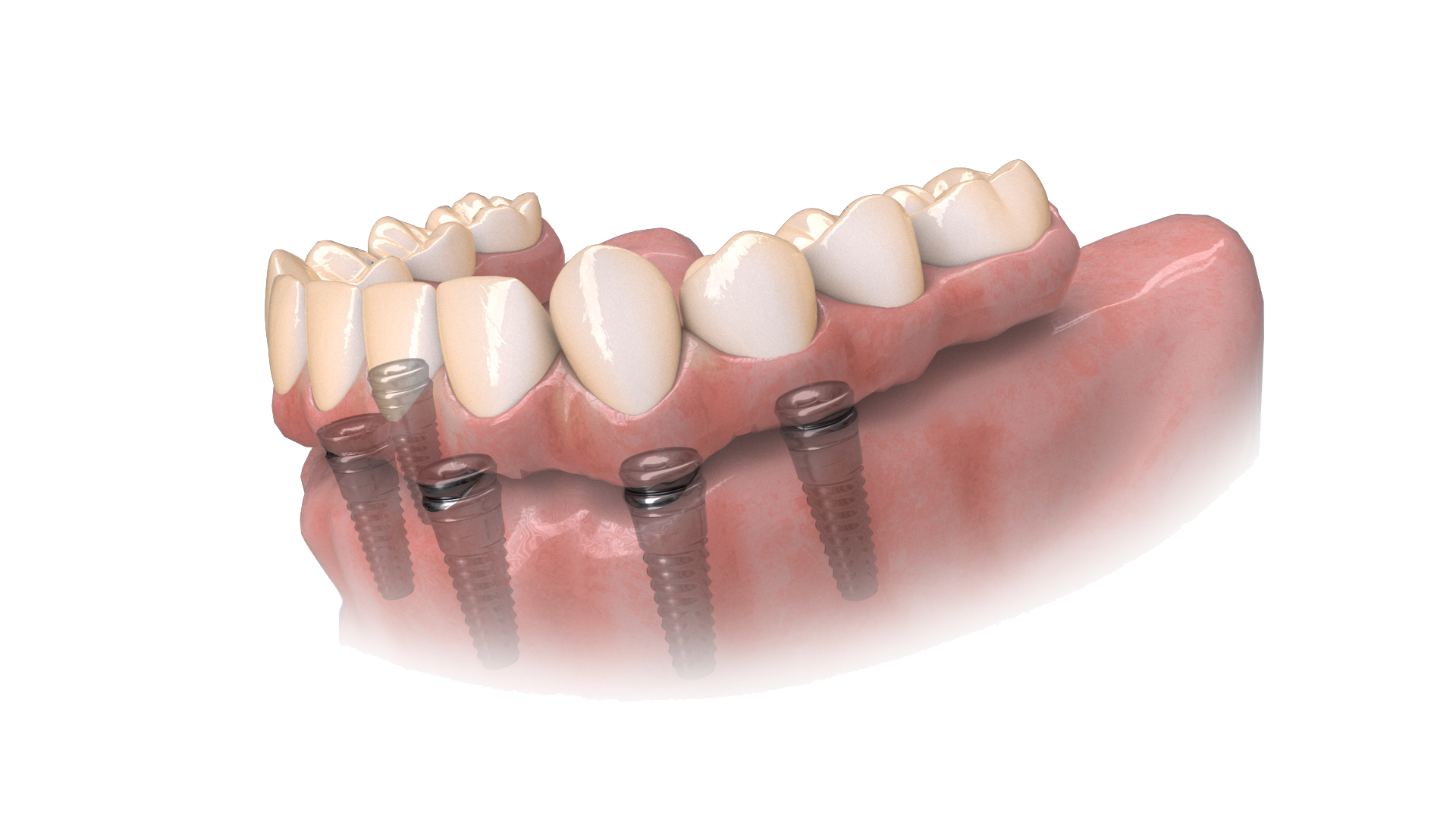 Dental Implant Example