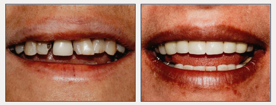 before and after of a dental patient with new cosmetic crowns and bridges