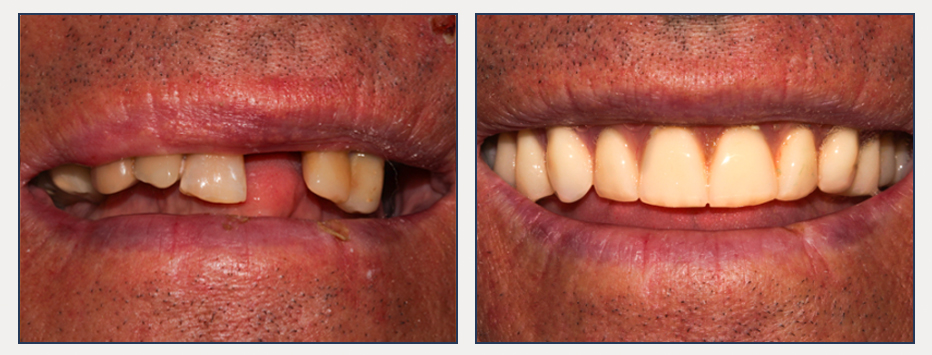 before and after of a dental patient with new denture