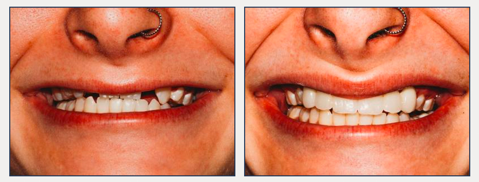 before and after of a dental patient with new cosmetic bridges