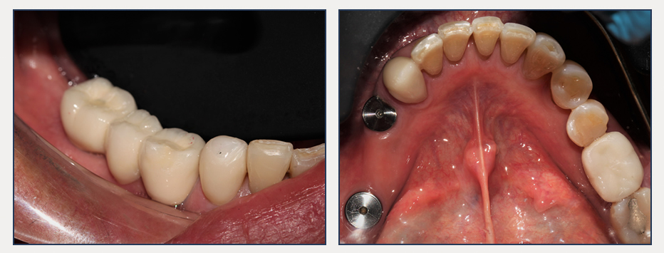 before and after of a dental patient with new cosmetic bridges