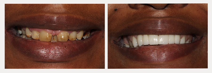 before and after of a dental patient with new crown and bridge prosthetics for eight teeth