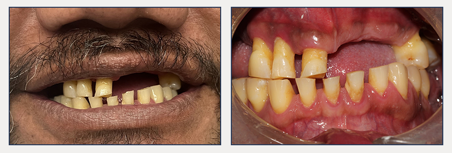 before and after of a dental patient with full mouth rehabilitation 2