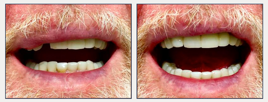 before and after of a dental patient with new implant and crown
