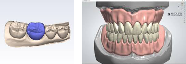 Planmeca-Crown.png and 3D-Computer-Denture.png