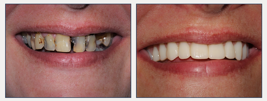 before and after of a dental patient with full mouth rehabilitation
