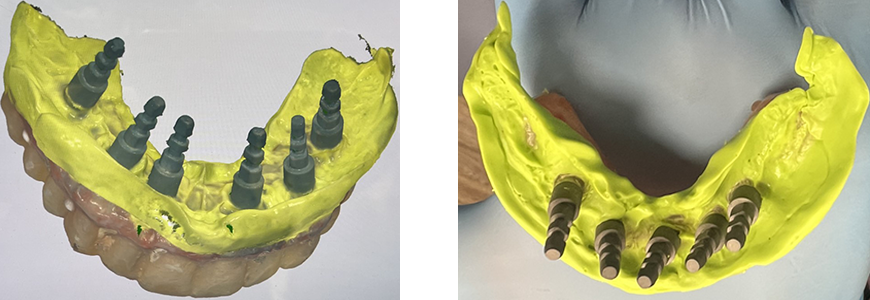 3D-Printed-Nightguard and Athletic-Mouthguard