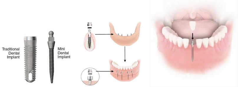 Mini Dental Implant Example