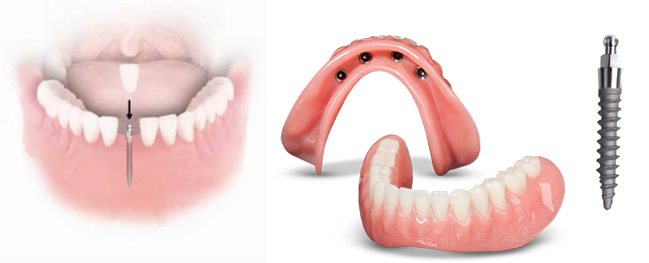 Mini Dental Implant Example