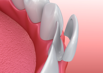 illustration of a dental veneer being placed on tooth